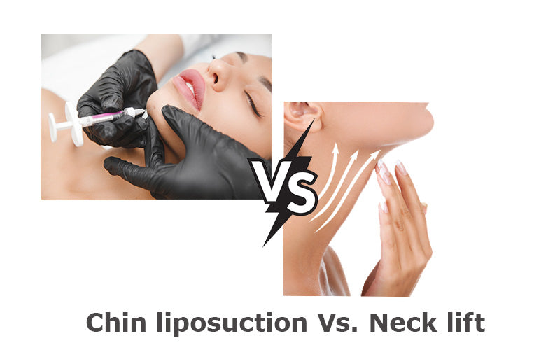 Chin liposuction Vs. Neck lift